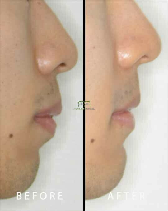 ext-face-before-after